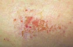 Severe baby Eczema